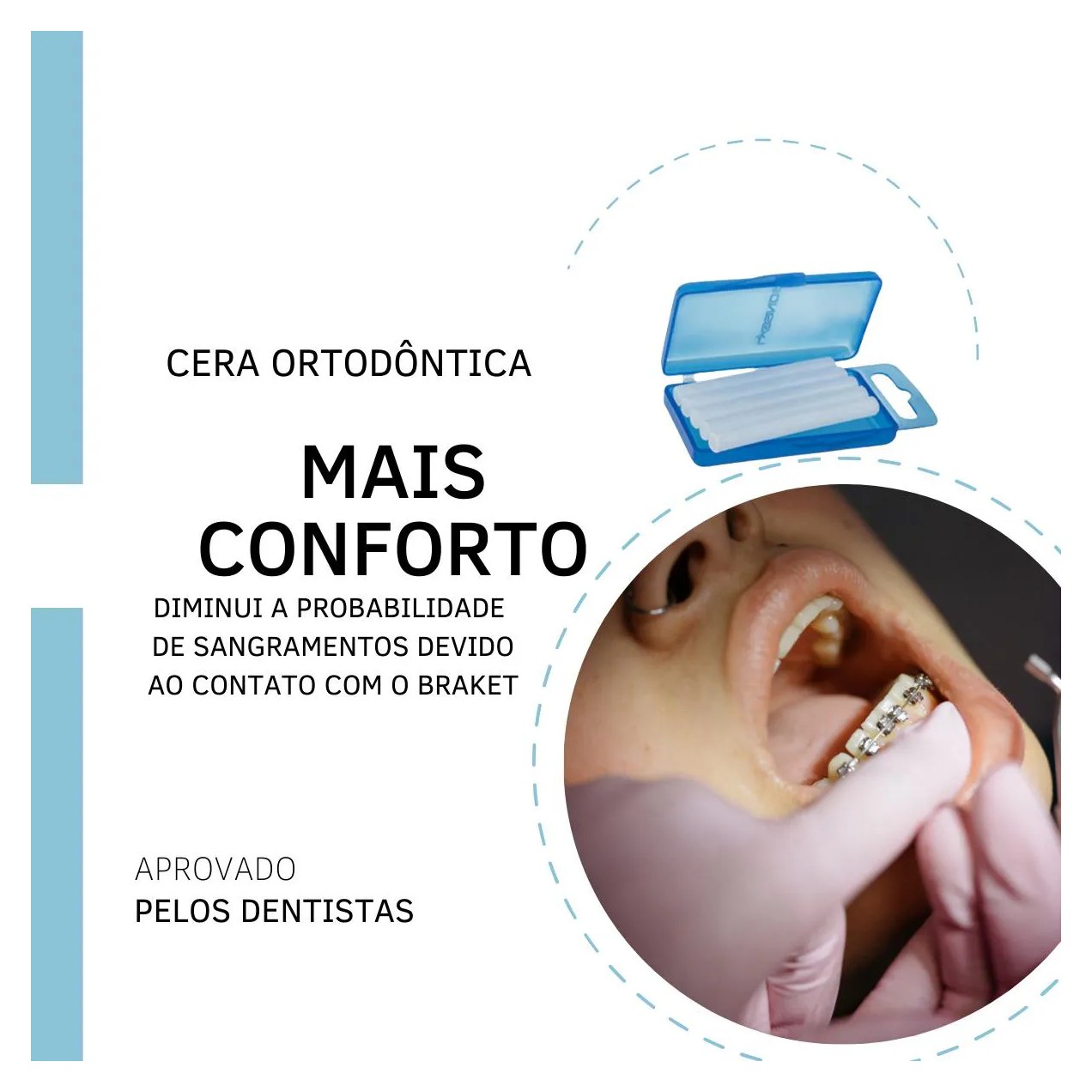 Cera Ortodôntica para Aparelho Proteção Labios 50 Bastões